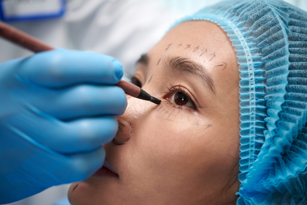 Blepharoplasty and Ptosis Surgery Cost in Hyderabad, India