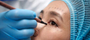 Blepharoplasty and Ptosis Surgery Cost in Hyderabad, India