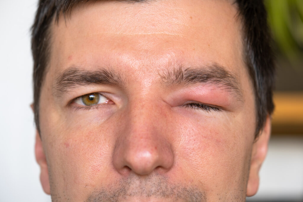 Chalazion vs Stye