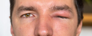 Chalazion vs Stye